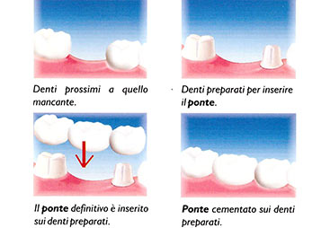 Ponte dentale - Dott.Marco Dormi Odontoiatra a Terni